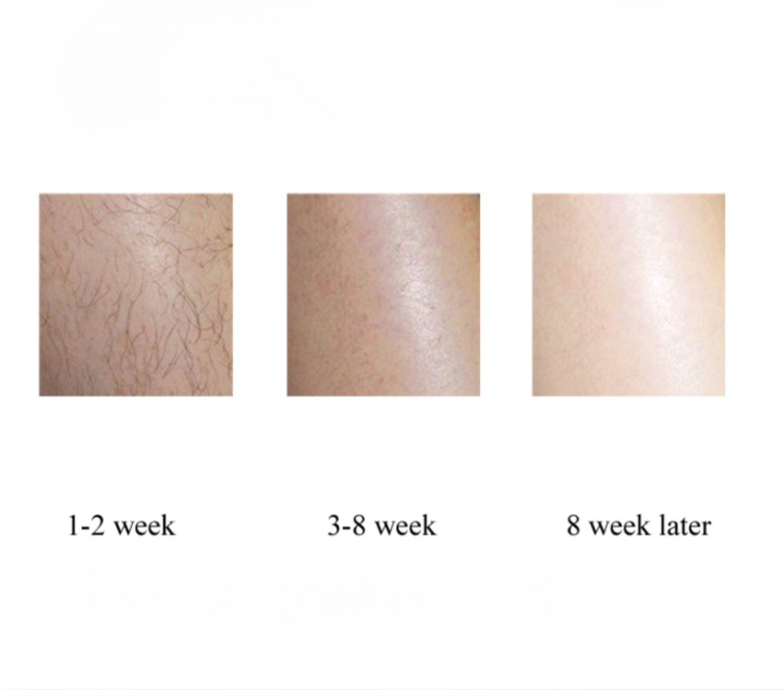 Epilateur laser lumière pulsée indolore pour bikini visage et corps 900000 Flash